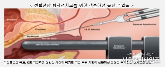 전립선암 방사선치료 생분해성 물질 주입술 예시